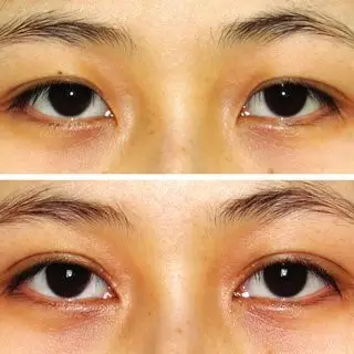 Double Eyelid Crease –In-fold Type